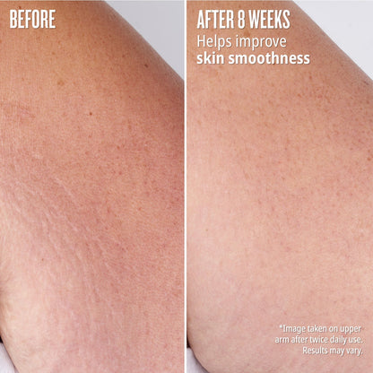 Before // After 8 weeks - helps improve skin smoothness. *image taken on upper arm after twice daily use. Results may vary.