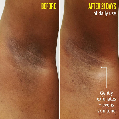 Before // After 21 days of daily use - gently exfoliates + evens skin tone